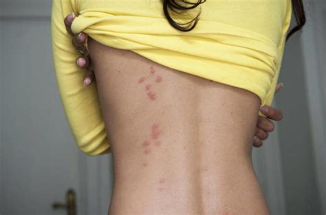 Bed Bug Bite What Are The Symptoms Of An Allergic Reaction