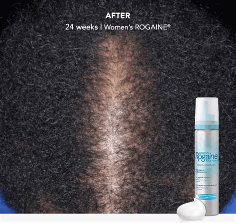 Hair Growth Products For Women Rogaine
