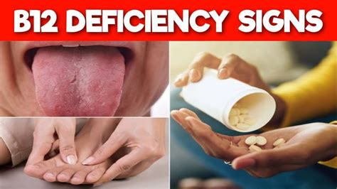 B12 Deficiency Symptoms 9 Signs And Symptoms Of Vitamin B12 Deficiency