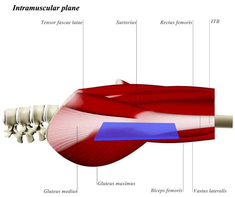 Hip Direct Lateral Approach Hardinge Transgluteal Approaches