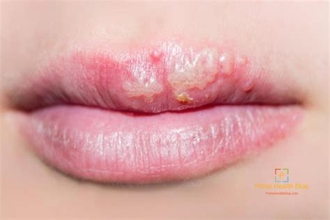 White Bumps On Lips Causes Diagnosis And Treatment 2022