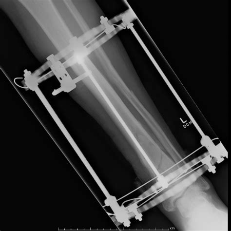 Distal Tibial Fractures The Bone School