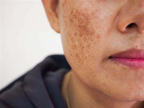 Tratamiento Del Melasma Y Las Manchas Faciales Tras El Verano Campusderma