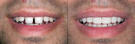 Composite Vs Porcelain Veneers Gm Dental Rochester