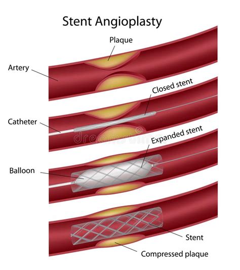 3 Stent Free Stock Photos Stockfreeimages