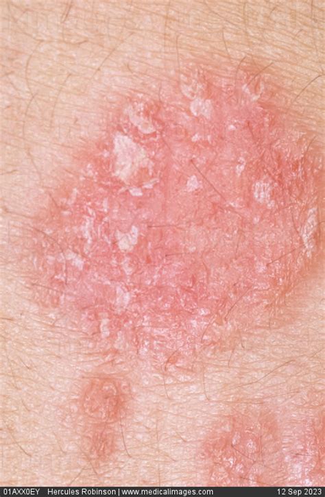 Stock Image Dermatology Psoriasis A Large Pink Slightly Raised Pink