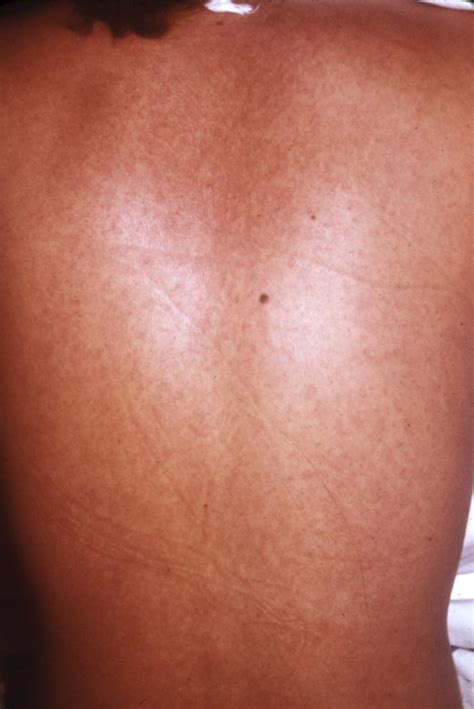 Marburg Virus Pictures Skin Rash 1 Hardin Md Cdc