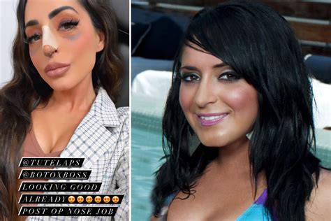 jersey shore s angelina pivarnick gets a nose job and shares graphic post plastic surgery photos