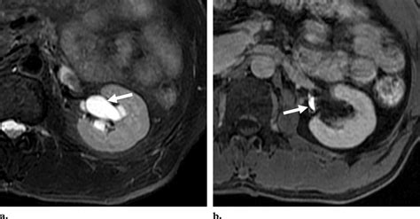 Renal Sinus Cyst Mimicking Hydronephrosis A Axial Fat Suppressed