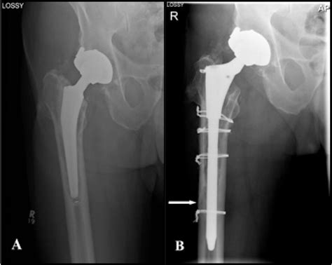 Figure 2 From Modified Extended Trochanteric Osteotomy With