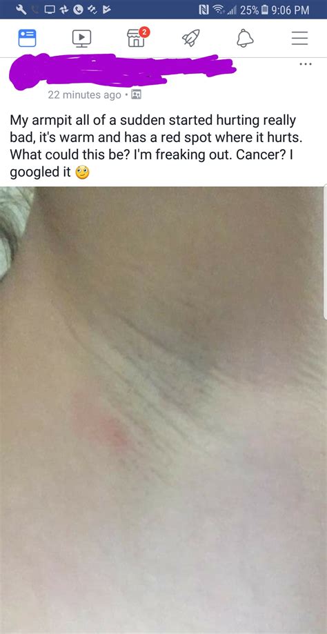 Armpit Cancer Images