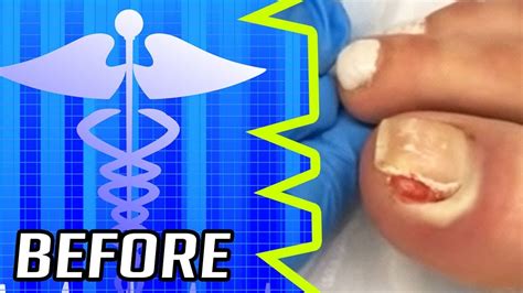 Worst Nails On Earth Ingrown Nails Cellulitis Nail Removal Youtube
