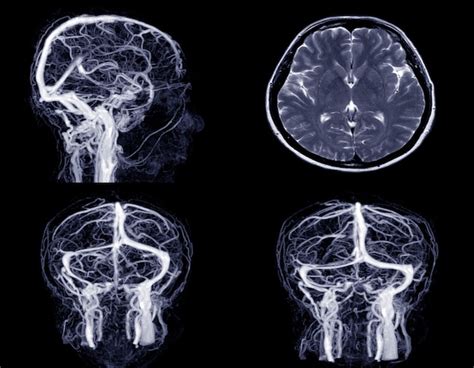 Imagen Médica Mrv Venografía Por Resonancia Magnética Cerebro De Las