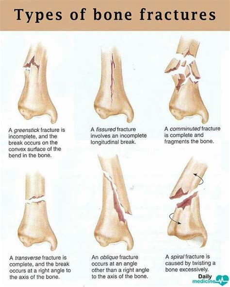 Types Of Bone Fractures Medical School Essentials Medical Student