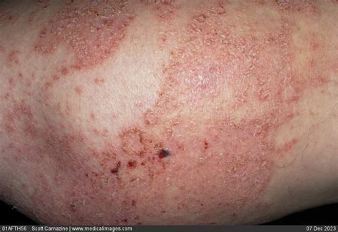 Stock Image Close Up Of Eczema Showing An Eczematous Skin Rash On The