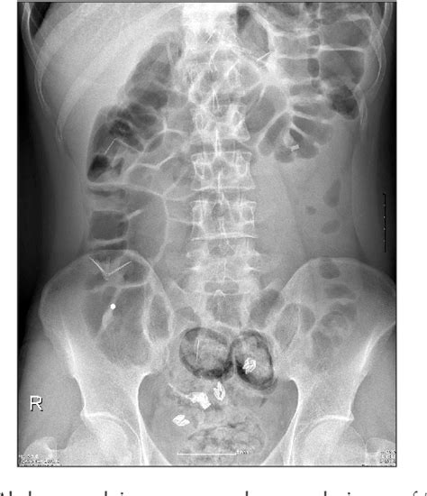 Figure 1 From Acute Appendicitis Caused By Foreign Body Ingestion