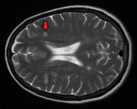 Risky Stem Cell Treatment Halts Ms In 70 Of Patients In Small Study