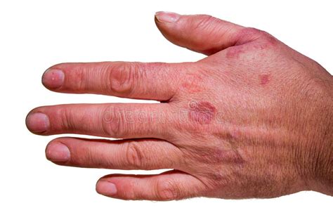Human Hand With Rash Eczema Stock Image Image Of Reactions Lesions
