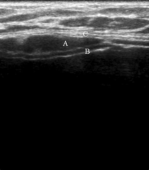 The Sonographic Appearances Of Breast Implant Rupture Clinical Radiology