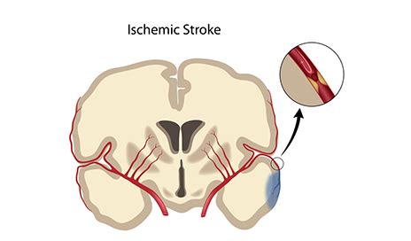 In these trials, patients with acute ischaemic stroke caused by occlusion of the proximal anterior artery circulation were randomly assigned to receive either endovascular thrombectomy within 12 4. DAWN Stroke Trial Results Suggest Significant Recovery ...