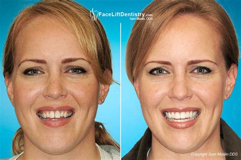 dental veneers to widen the smile