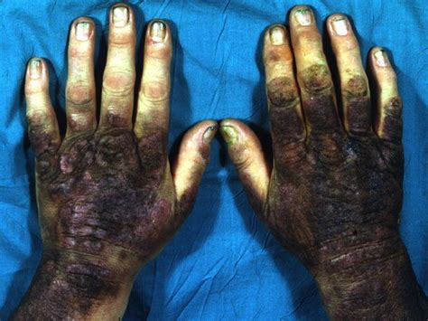 Coal tar is derived from coal. Coal Tar for Psoriasis - 100-Year-Old Remedy for Psoriasis ...