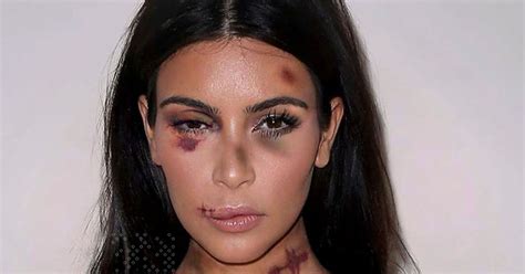 Kim Kardashian ‘bruised And Battered And Left With Black