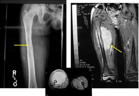 Ewing Sarcoma Bone Tumor Cancer Tumors Of The Bone