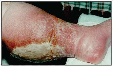 Skin Infection On Both Legs Caused By Acremonium Strictum Case Report