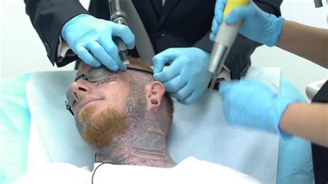 Crazy Video Of Man Getting Face Tattoo Removed Tattooremovaldiy