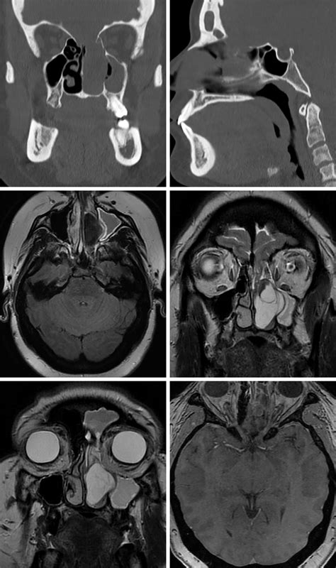 Encephalocele The Neurosurgical Atlas