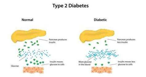 Type 2 Diabetes Risk Factors Symptoms Diagnosis And Treatment