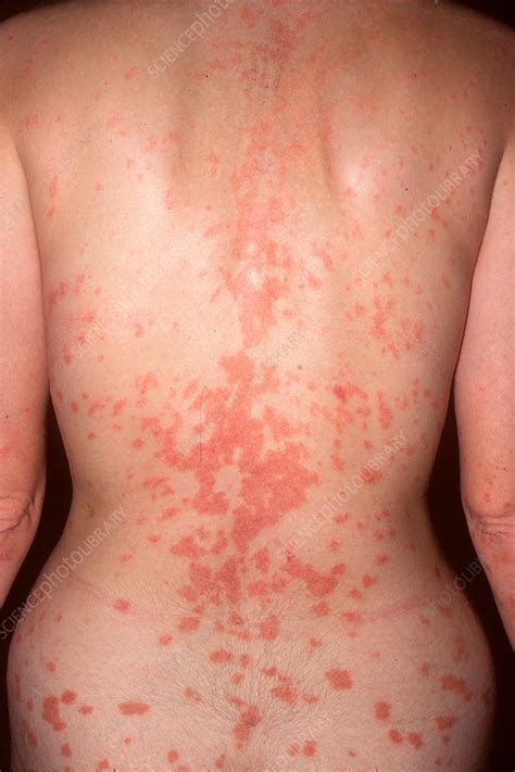 Guttate Psoriasis Stock Image C0372750 Science Photo Library