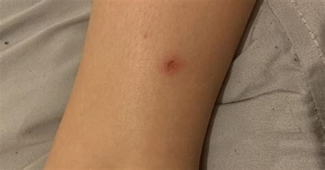 Spider Bite