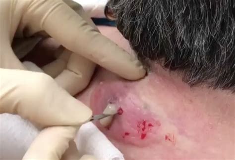 Sebaceous Cyst Rupture Under Skin Thaipolicepluscom