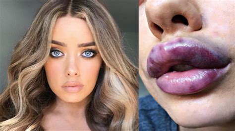 Beauty Bloggers Lips “die” Turn Blue After Botched Lip Fillers The