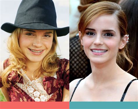 Celebrities With Braces Before And After Australian Society Of