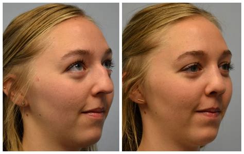 Septoplasty Only Before And After