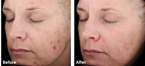Chemical Peels An A Peel Ing Lift Comprehensive Dermatology Center