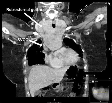 Extended Retrosternal Goitre With Superior Vena Cava Obstruction The Bmj