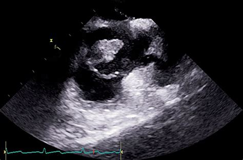 Infective Endocarditis Due To Atopobium Vaginae A Rare Association