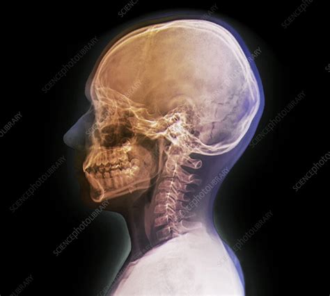 Normal Childs Head X Ray Stock Image F0033524 Science Photo