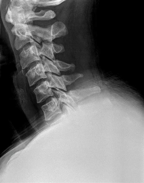 X Ray Of A Human Cervical Spine Photograph By Photostock Israel Fine