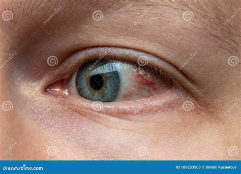 Sick Red Eye Of Tired Man Stock Image Image Of Medicine 189253503