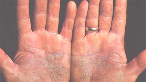 Psoriasis Vs Eczema What Is The Difference
