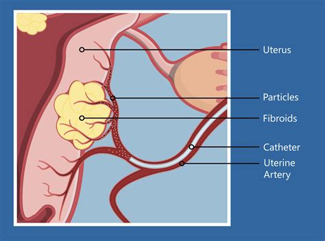 Uterine Fibroids And Stress Fibroid Institute Texas