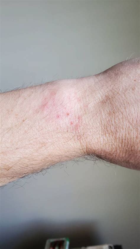 Solved Galaxy Watch Skin Rashwrist Pains Page 15 Samsung
