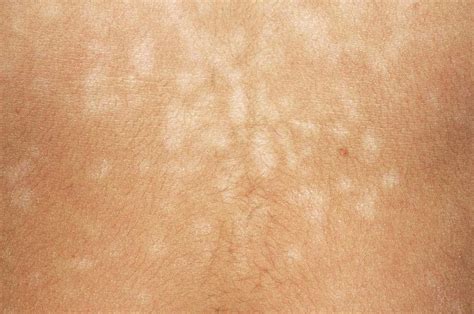 Pityriasis Versicolor Skin Infection Photograph By Dr P Marazzi