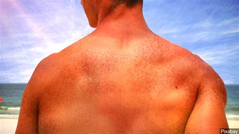 Tips For Preventing Skin Cancer Or Catching It Early