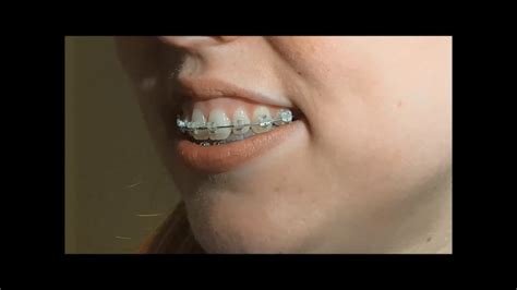 How To Apply Orthodontic Wax To Braces Braces By Dr Ruth How To
